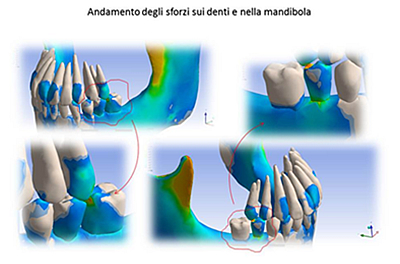 Assieme 3D impianto_osso corticale
